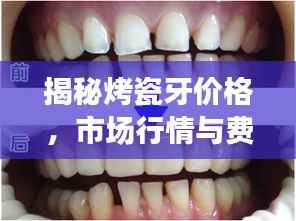 揭秘烤瓷牙价格,市场行情与费用解析